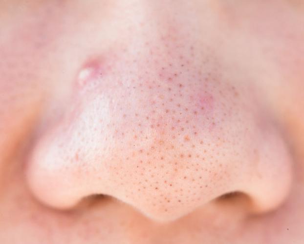 Trị Mụn Viêm Mụn Mủ Tại Sen Beauty